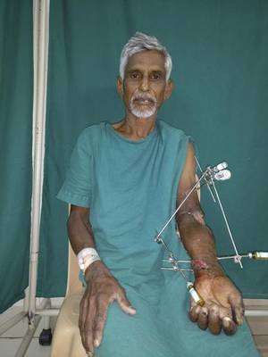 The forearm of Subbanna, a resident of Chamrajnagar, got severed when it came under one of the wheels of a train. | Photo Credit: The Hindu 