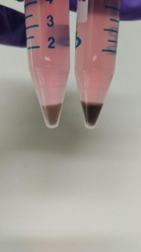 Two vials showing stem cell modified Retinal Pigment Epithelium cells (which appear brown/black). The quantity of each vial is enough for five patients. PIC Courtesy: Dr Jogin Desai 